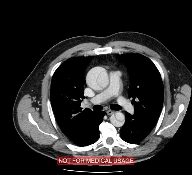 File:Acute aortic dissection - Stanford type A (Radiopaedia 40661-43285 Axial C+ portal venous phase 18).jpg