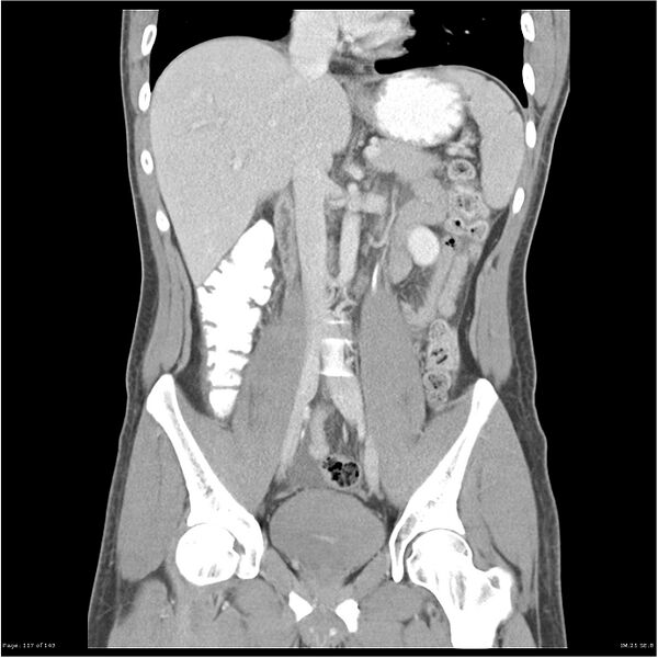 File:Acute appendicitis (Radiopaedia 25364-25615 C+ portal venous phase 14).jpg