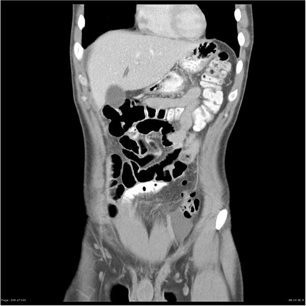 File:Acute appendicitis (Radiopaedia 25364-25615 C+ portal venous phase 3).jpg