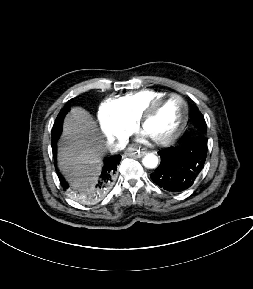 Acute arterial mesenteric ischemia (Radiopaedia 78238-90828 Axial C+ arterial phase 16).jpg