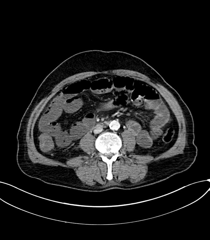 Acute arterial mesenteric ischemia (Radiopaedia 78238-90828 Axial C+ portal venous phase 75).jpg