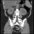 Acute cholecystitis and ureteric colic (Radiopaedia 42330-45444 Coronal prone 70).jpg