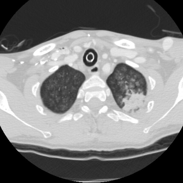 File:Acute diffuse alveolar hemorrhage (Radiopaedia 41323-44158 Axial lung window 3).jpg