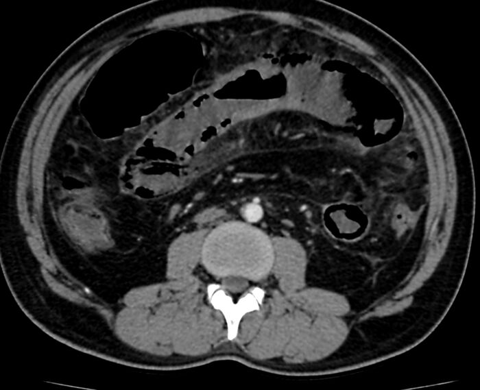 Acute mesenteric ischemia - superior mesenteric artery thrombosis (Radiopaedia 73947-84776 Axial C+ arterial phase 64).jpg