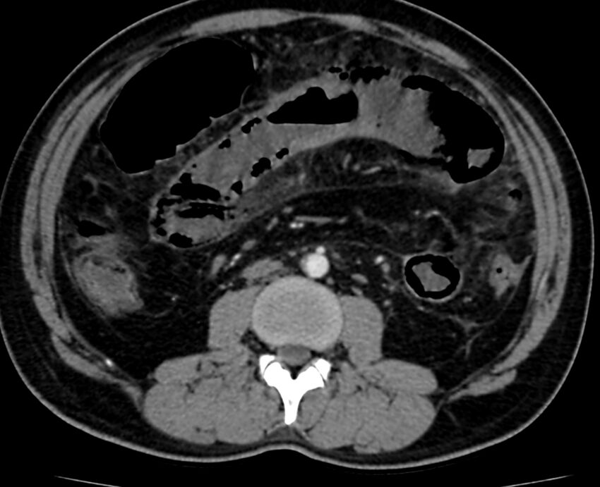 Acute mesenteric ischemia - superior mesenteric artery thrombosis (Radiopaedia 73947-84776 Axial C+ arterial phase 64).jpg