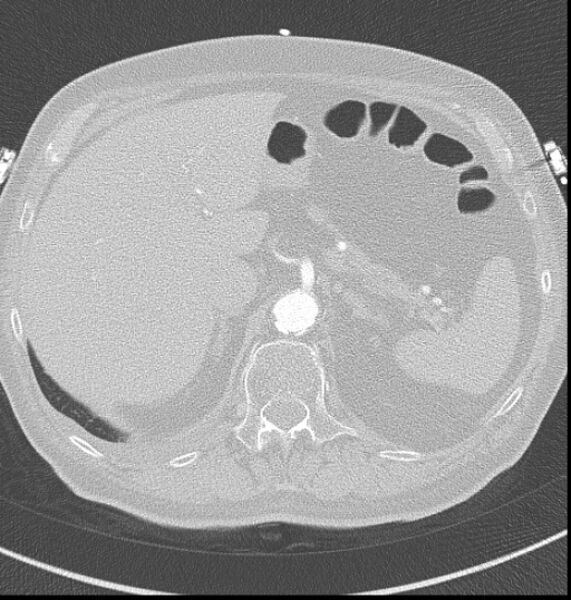 File:Acute myocardial infarction (Radiopaedia 23413-23481 lung window 75).jpg