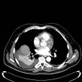 Acute pancreatic necrosis (Radiopaedia 13560-18500 Axial C+ portal venous phase 4).jpg