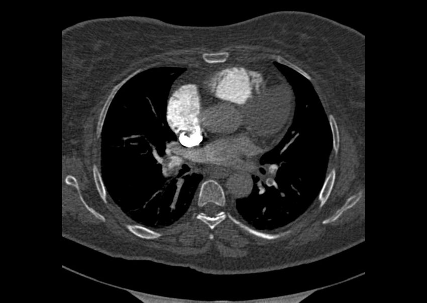Acute pulmonary embolism (Radiopaedia 29938-30466 Axial C+ CTPA 94).jpg