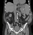 Acute renal failure post IV contrast injection- CT findings (Radiopaedia 47815-52557 Coronal non-contrast 23).jpg