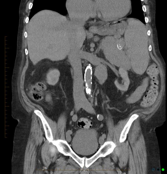 File:Acute renal failure post IV contrast injection- CT findings (Radiopaedia 47815-52557 Coronal non-contrast 23).jpg