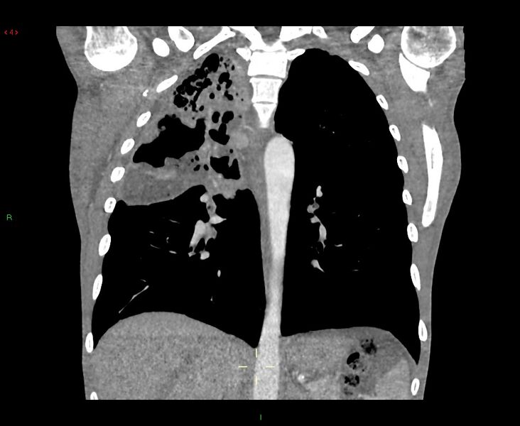 File:Acute right lung abscess (Radiopaedia 34806-36258 Coronal C+ arterial phase 22).jpg