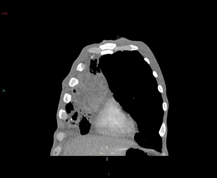 File:Acute right lung abscess (Radiopaedia 34806-36258 Coronal C+ arterial phase 49).jpg