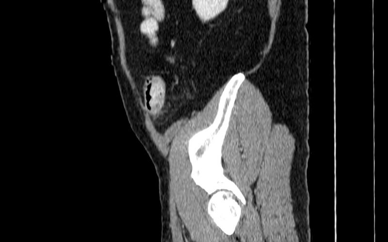 File:Acute sigmoid colon diverticulitis (Radiopaedia 55507-61976 Sagittal C+ portal venous phase 116).jpg