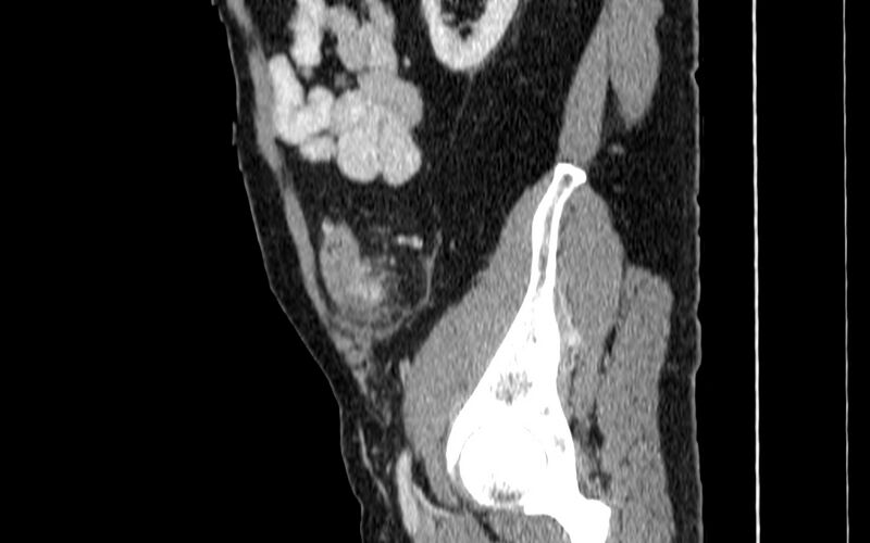 File:Acute sigmoid colon diverticulitis (Radiopaedia 55507-61976 Sagittal C+ portal venous phase 91).jpg