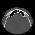 Acute sinusitis (Radiopaedia 23161-23215 Axial bone window 66).jpg