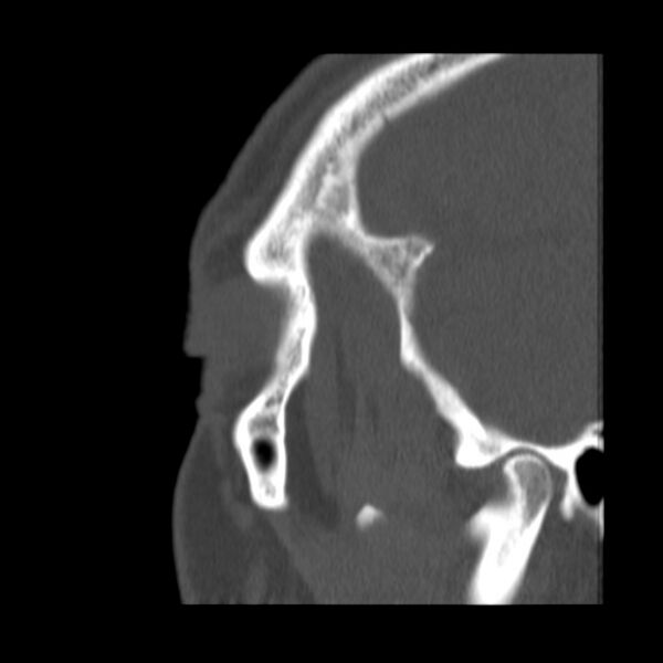 File:Acute sinusitis (Radiopaedia 23161-23215 Sagittal bone window 9).jpg