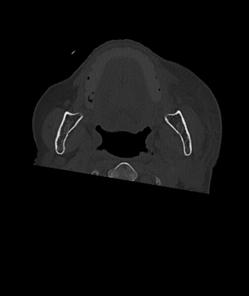 File:Acute traumatic subdural hematoma (Radiopaedia 82921-97257 Axial bone window 116).jpg