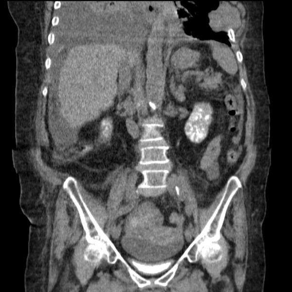 File:Acute tubular necrosis (Radiopaedia 28077-28334 G 49).jpg