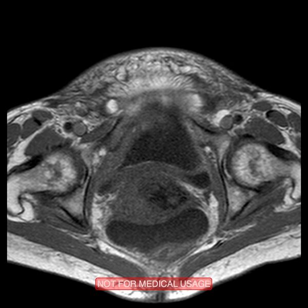 File:Adenocarcinoma of the cervix (Radiopaedia 28373-28615 Axial T1 7).jpg