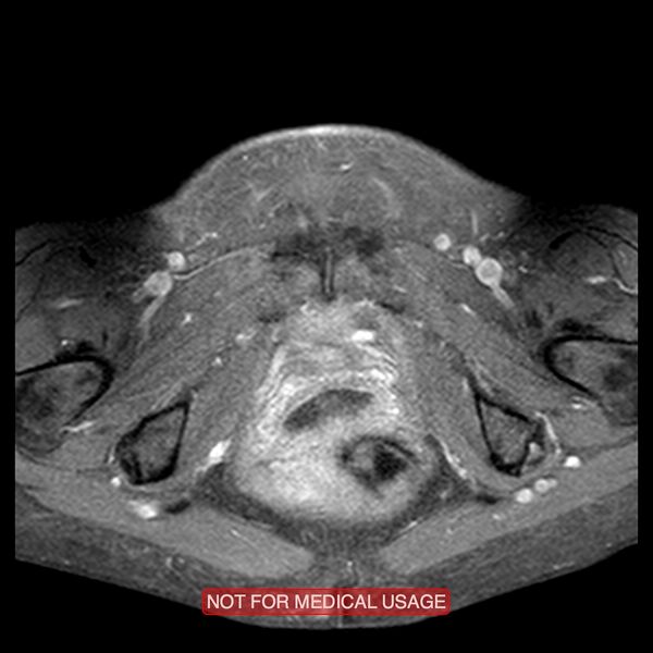 File:Adenocarcinoma of the cervix (Radiopaedia 28373-28615 Axial T1 C+ fat sat 3).jpg