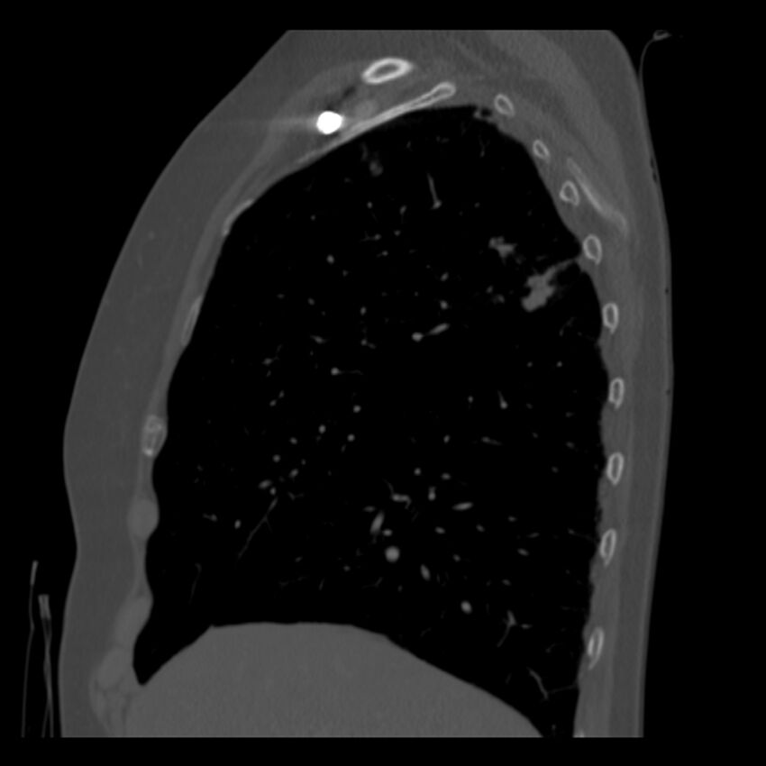 Adenocarcinoma of the lung (Radiopaedia 41015-43755 Sagittal bone window 25).jpg