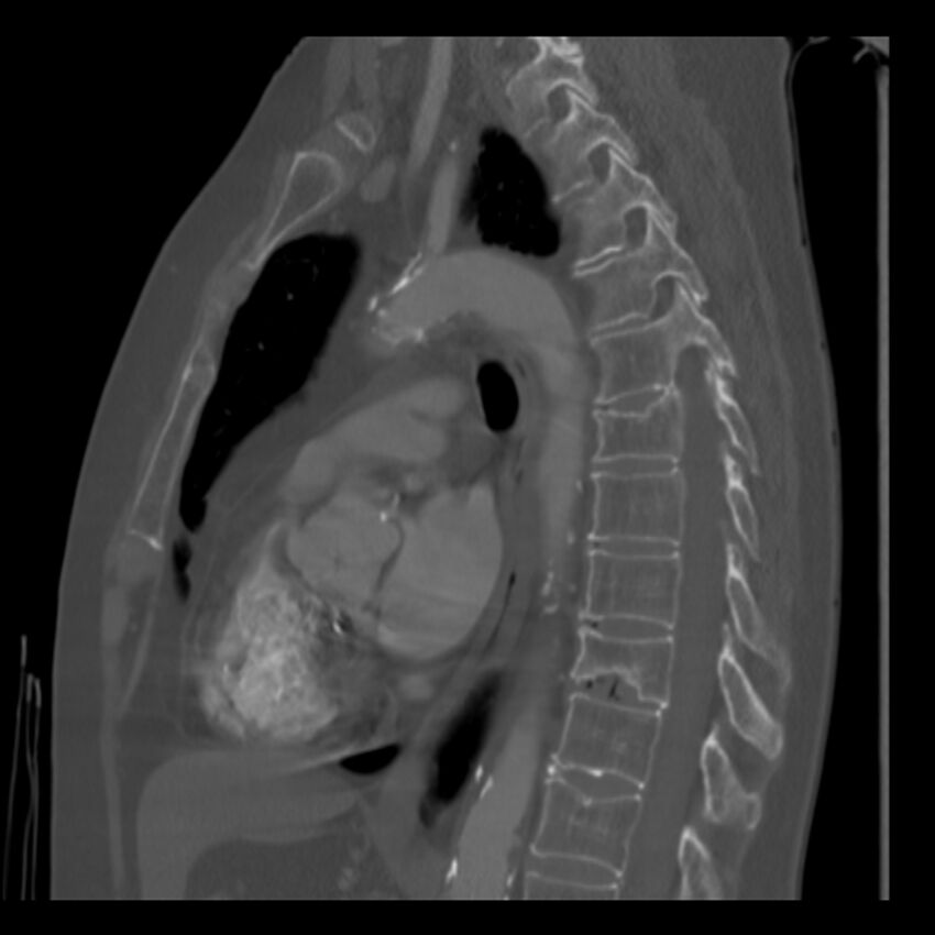 Adenocarcinoma of the lung (Radiopaedia 41015-43755 Sagittal bone window 57).jpg