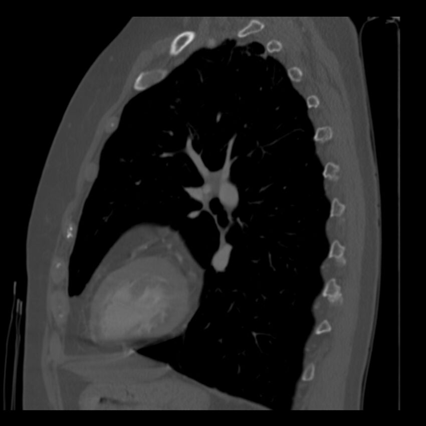 Adenocarcinoma of the lung (Radiopaedia 41015-43755 Sagittal bone window 69).jpg