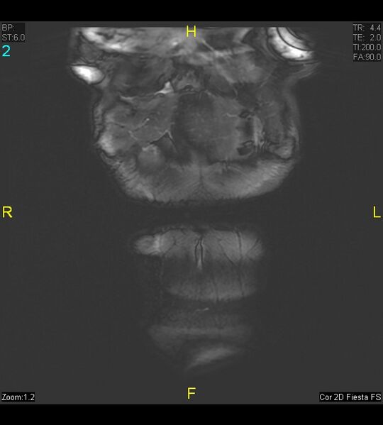 File:Adenomyosis (Radiopaedia 43504-46889 Coronal 2D FIESTA 2).jpg