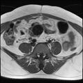 Adenomyosis - ovarian endometriomas (Radiopaedia 67031-76350 Axial T1 3).jpg