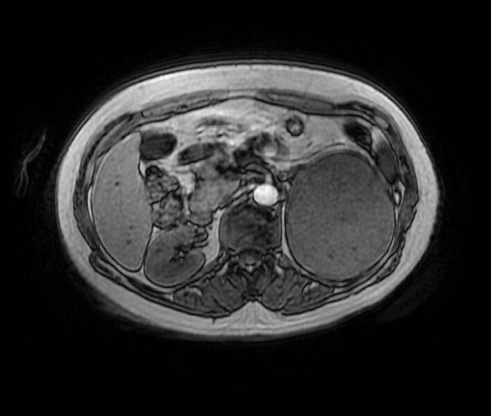 File:Adrenal cortical carcinoma (Radiopaedia 70906-81116 Axial T1 in-phase-out-of-phase 19).jpg