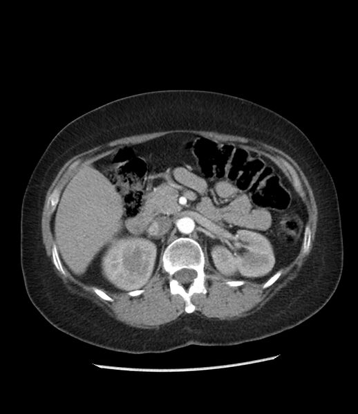 File:Adrenal cortical carcinoma with IVC invasion and thrombosis (Radiopaedia 34307-35597 Axial C+ arterial phase 33).jpg