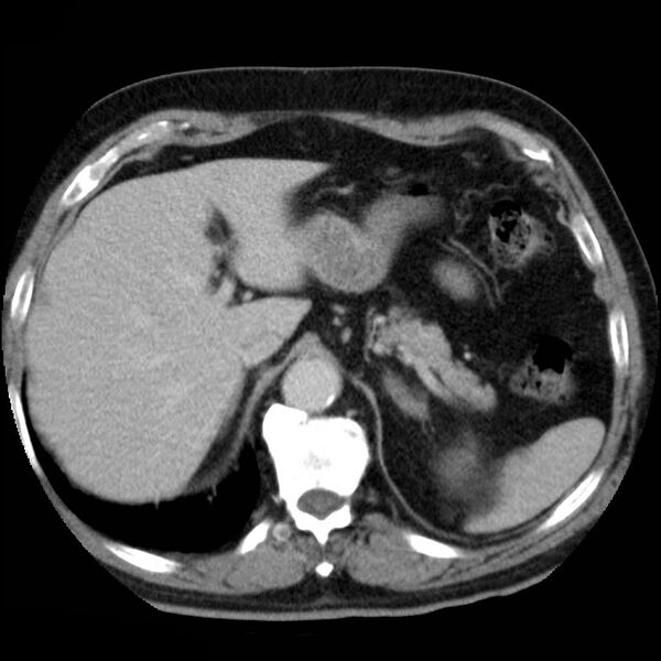 File:Adrenal hemangioma (Radiopaedia 11039-11445 Axial C+ portal venous phase 2).jpg