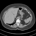 Adrenal hemangioma (Radiopaedia 33078-34103 Axial non-contrast 15).png