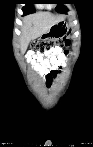 File:Agenesis of the gallbladder (Radiopaedia 55454-61905 A 8).jpg
