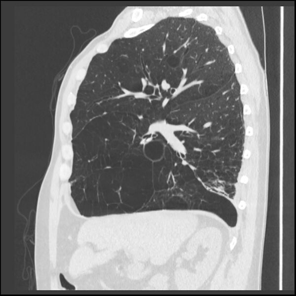 File:Alpha-1-antitrypsin deficiency (Radiopaedia 40993-43722 Sagittal lung window 177).jpg