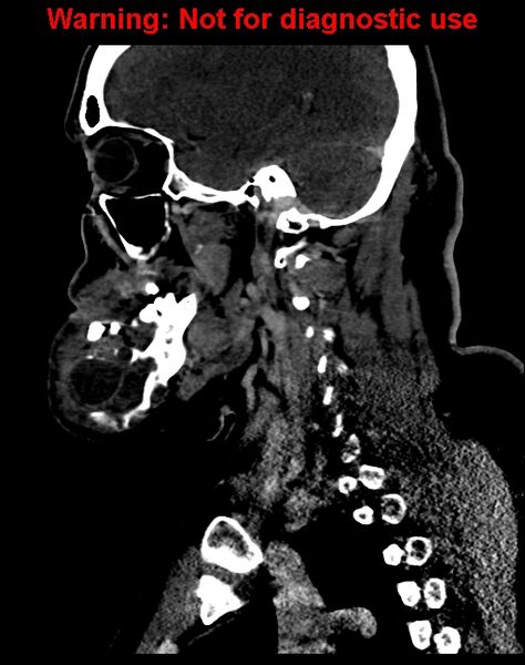 File:Ameloblastoma (Radiopaedia 33126-34164 F 47).jpg