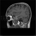 Amnestic syndrome secondary to hypoxic brain injury (Radiopaedia 24743-25004 T1 4).jpg