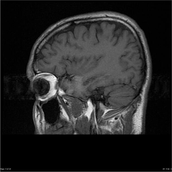 File:Amnestic syndrome secondary to hypoxic brain injury (Radiopaedia 24743-25004 T1 4).jpg