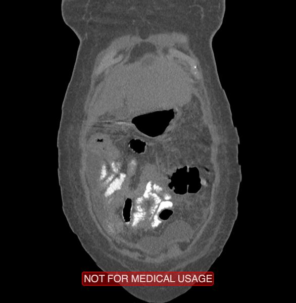 File:Amoebic enterocolitis with liver abscess (Radiopaedia 35100-36609 B 8).jpg