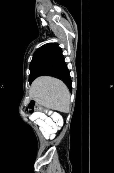 File:Ampullary adenocarcinoma (Radiopaedia 86093-102033 E 10).jpg
