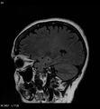 Amyotrophic lateral sclerosis (Radiopaedia 5373-7134 Sagittal FLAIR 20).jpg