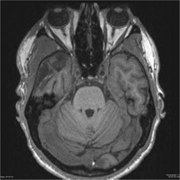 File:Anaplastic meningioma with recurrence (Radiopaedia 34452-35788 Axial T1 38).jpg