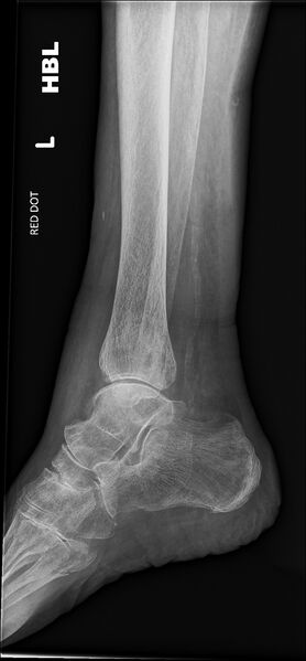 File:Ankle and metatarsal fracture - satisfaction of search (Radiopaedia 79231-92240 Lateral 1).jpg