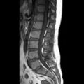 Ankylosing spondylitis with zygapophyseal arthritis (Radiopaedia 38433-40516 Sagittal T1 5).jpg
