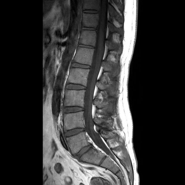 File:Ankylosing spondylitis with zygapophyseal arthritis (Radiopaedia 38433-40516 Sagittal T1 5).jpg