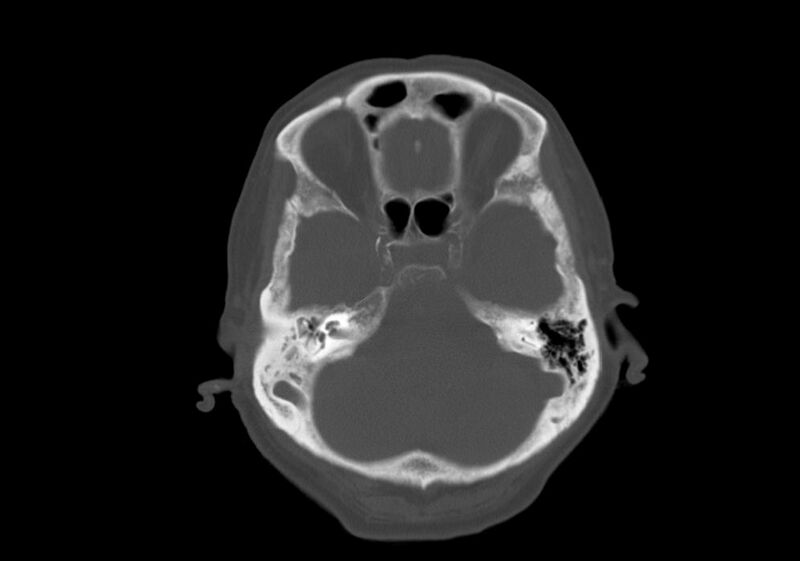File:Anomalous intracranial venous drainage (Radiopaedia 28161-28418 Axial bone window 9).jpg