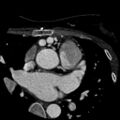 Anomalous left coronary artery from the pulmonary artery (ALCAPA) (Radiopaedia 40884-43586 A 14).jpg