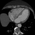 Anomalous origin of left circumflex artery from right coronary sinus (Radiopaedia 72563-83117 B 109).jpg