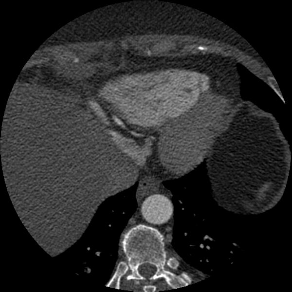 File:Anomalous origin of left circumflex artery from right coronary sinus (Radiopaedia 72563-83117 B 152).jpg