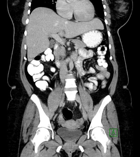 File:Anterior abdominal wall CSF pseudocyst (CSFoma) (Radiopaedia 79453-92571 B 29).jpg